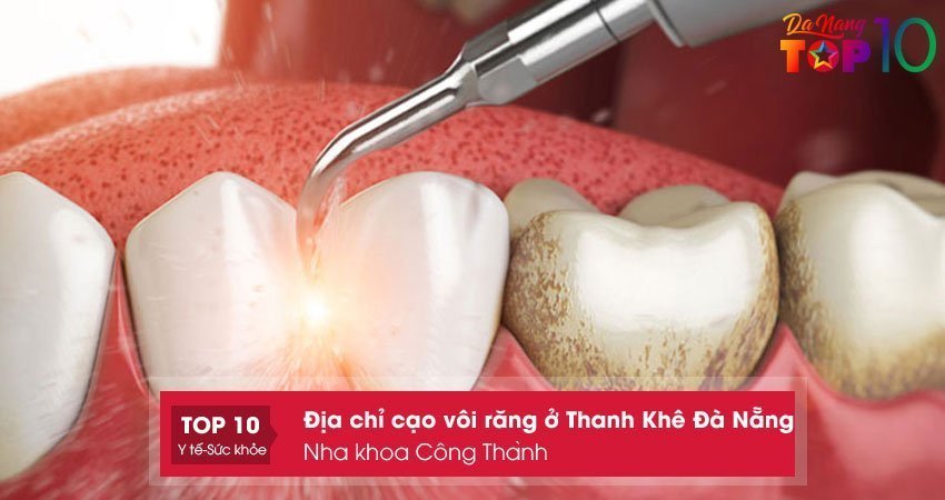 nha-khoa-cong-thanh-cao-voi-rang-o-thanh-khe-da-nang-uy-tin-top10danang