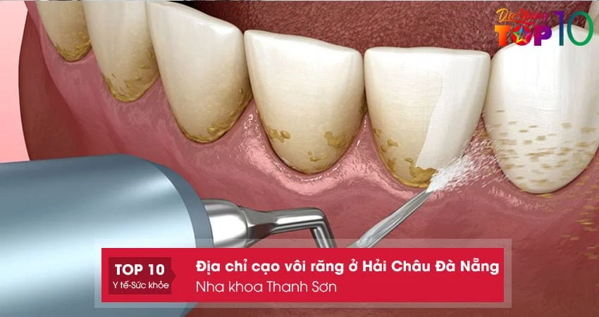 nha-khoa-thanh-son-top10danang