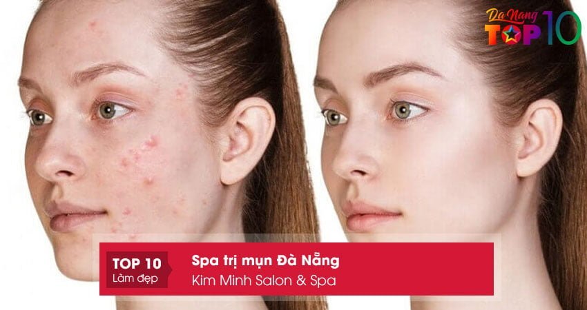 kim-minh-salon-spa-spa-tri-mun-da-nang-uy-tin-nhat-top10danang