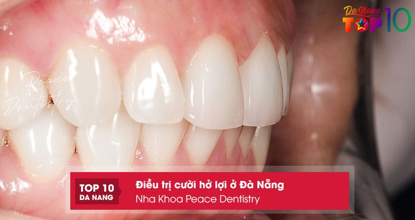 Nha-khoa-peace-dentistry-top10danang