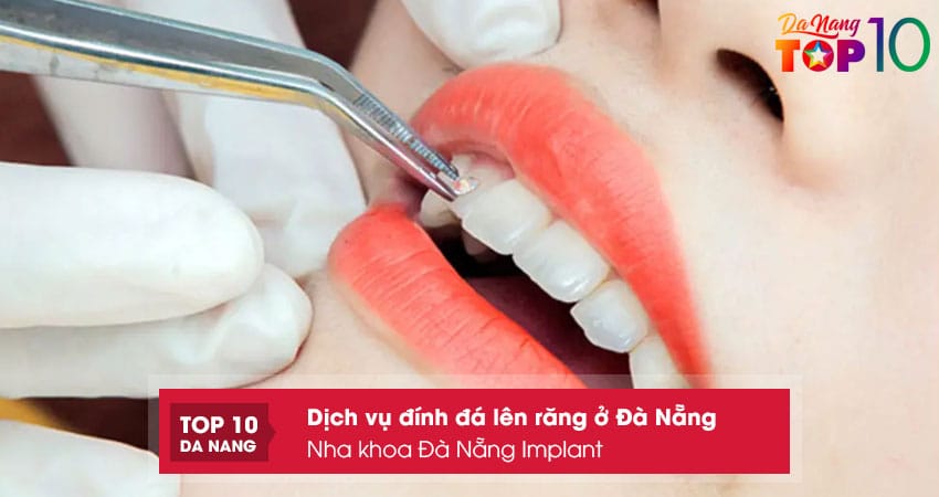Nha-khoa-da-nang-implant-top10danang