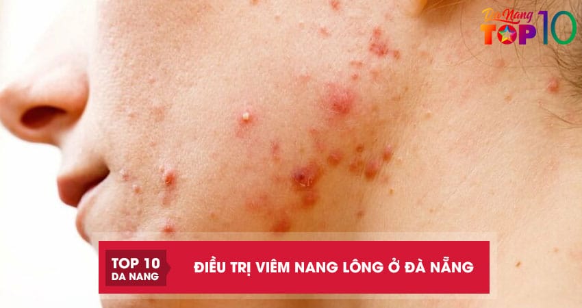 Top-10-dia-chi-dieu-tri-viem-nang-long-o-da-nang-hieu-qua-lau-dai-top10danang