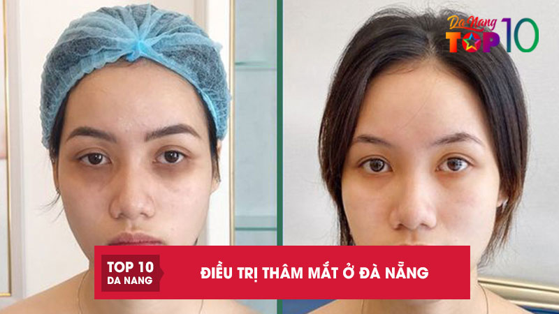 Top-10-dieu-tri-tham-mat-o-da-nang-hieu-qua-sau-1-lieu-trinh-top10danang